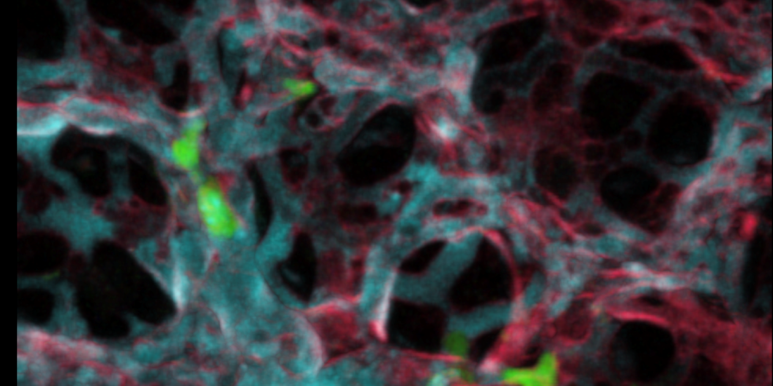 Understanding Immune Basis for Diseases: Cancer and Beyond